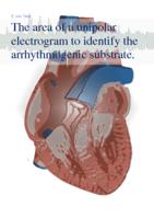 The area of a unipolar electrogram to identify the arrhythmogenic substrate